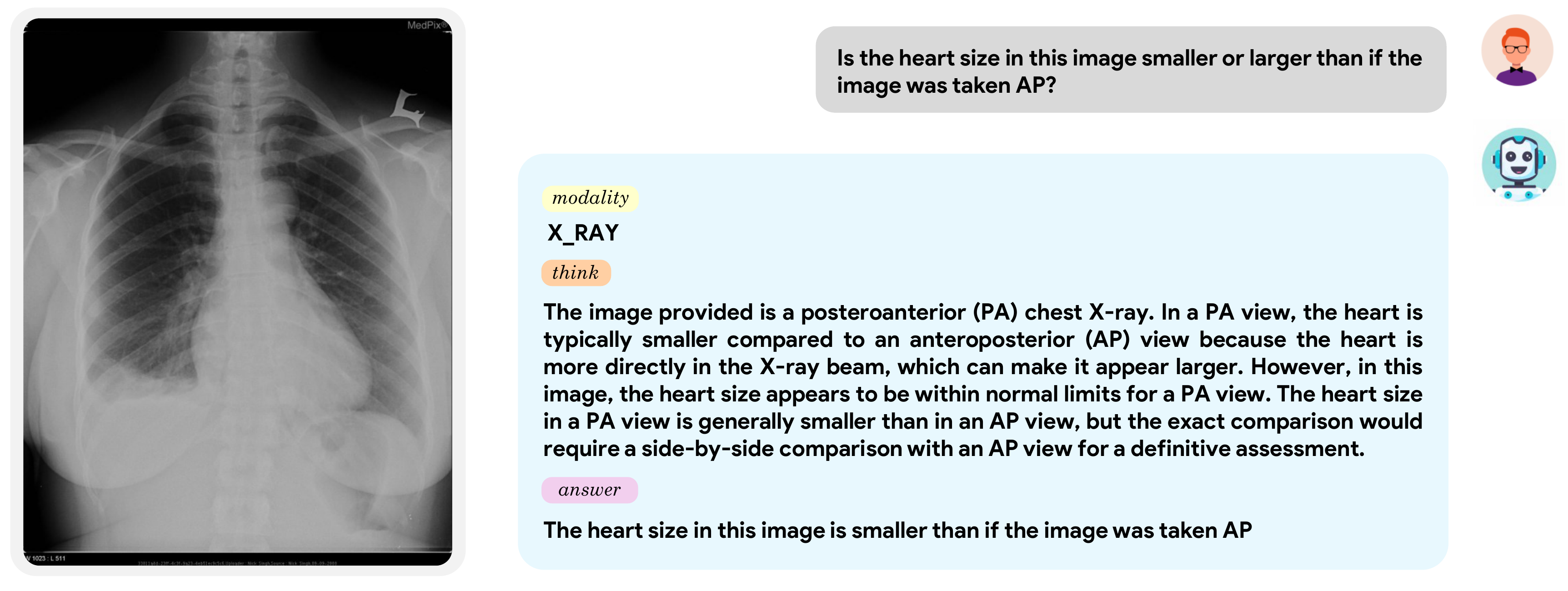 Radiology example — MediX-R1 explains heart size in PA vs AP view